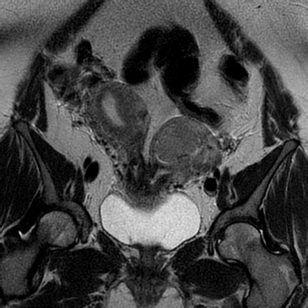 Uterus Didelphys Radiology Case Radiopaedia Org