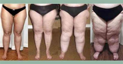 Lipedema You Know What Discover The Impact On Women S Lives Sad