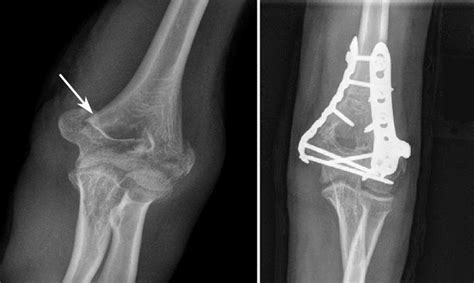 Distal Humerus Fractures Of The Elbow Orthoinfo Aaos