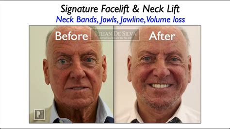 What Happens In A Neck Lift Animation Of A Neck Lift Procedure Youtube