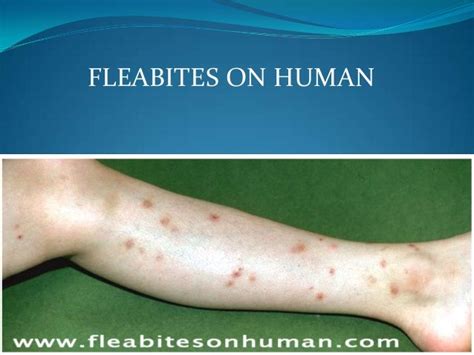 Pics Of Flea Bites On Human Pictures Photos