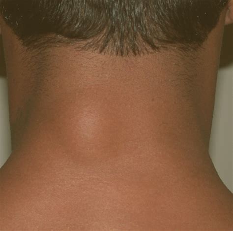Lump On Back Of Neck Pictures Causes And Treatment