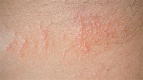 Causes Of Summertime Rashes