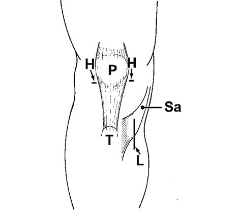 Positions Of The Skin Incisions H Horizontal Skin Incision For