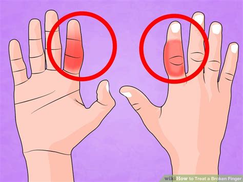 how to treat a broken finger laptrinhx