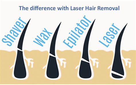Laser Hair Reduction Treatment In Gurgaon