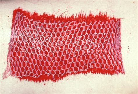 Mesh Skin Graft Attached To Burn Injury Photograph By James Stevenson