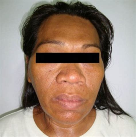 Coarsened Facial Features Of A 46 Year Old Female Diagnosed With