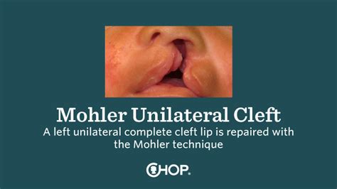 Mohler Unilateral Cleft Lip Repair Surgical Tutorial For Professionals