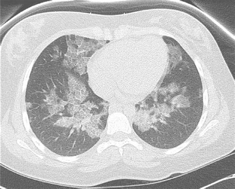 Chest Ct Of A Patient With Pap Demonstrating Interlobular And