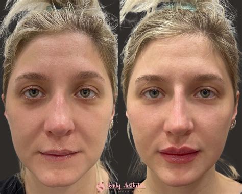Cheek Fillers Before And After Results At Skinly