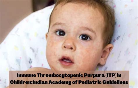 Immune Thrombocytopenic Purpura Itp In Children Iap Guidelines