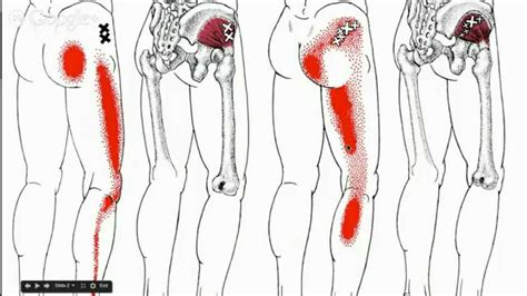 If you'd like to support us and get something great in return, check out our osce checklist booklet containing over 120 osce lower brainstem and upper cervical cord lesions can interfere with the function of cranial nerve xi, leading to paresis or paralysis of the trapezius (and. Low Back Pain / Sciatica and Gluteal Trigger Points - YouTube