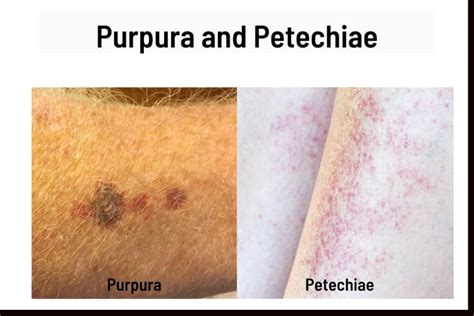 Red Spots On Skin 38 Causes Pictures And Treatment