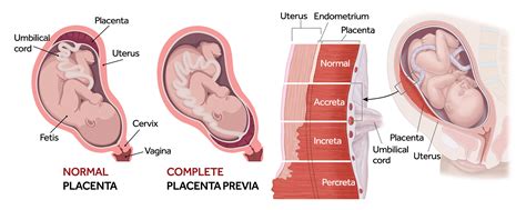 Center For Placenta Accreta Spectrum Stony Brook Medicine