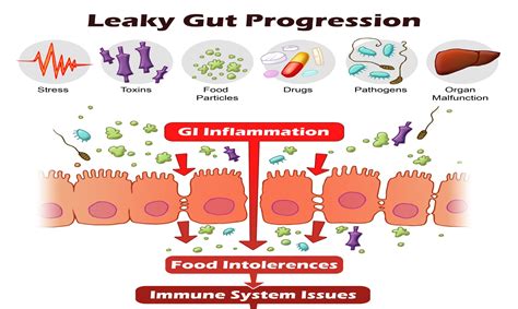Causes Of Leaky Gut Syndrome Leaky Gut Progression North Shore