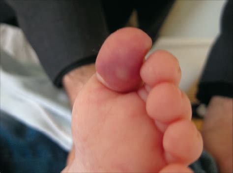 Blue Toe Syndrome As A Complication Of Intra Arterial Chemotherapy For