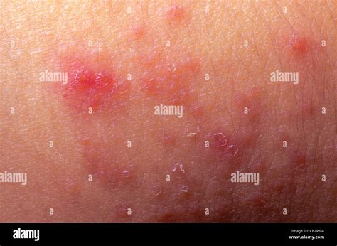 Eczema Atopic Dermatitis Symptom Skin Detail Texture Stock Photo Alamy