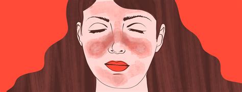 What Is A Malar Rash And How Do I Deal With It