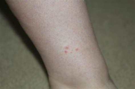 Bedbug Bites On Foot Econo Lodge Lemon Grovebedbug Bites On Ankle Econo