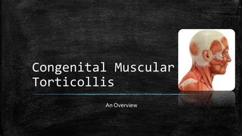 Congenital Muscular Torticollis Ppt