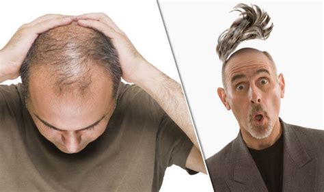 A Cure For Baldness Scientists Discover New Medicine Health Life