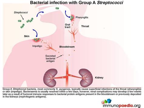 Post Streptococcal Glomerulonephritis Psgn Immunopaedia