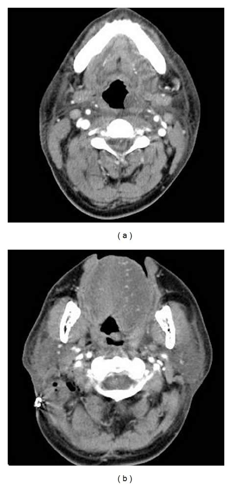 Postoperative Contrast Enhanced Computed Tomography Of The Neck