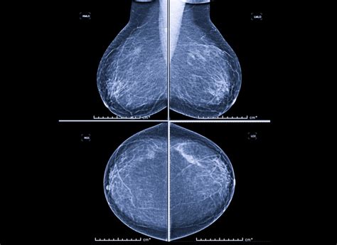 Risk Factors For Benign Breast Conditions Identified Harvard Health