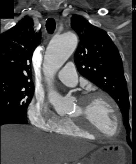 Aortic Valve Replacement With Dilated Ascending Aorta Cardiac Case