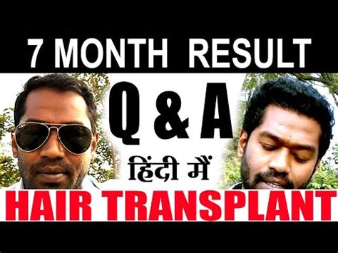Risks and costs of treatment. Hair Transplant (😉Result After 7 Months) - YouTube