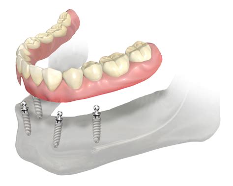 Proteze Dentare Tipuri Etape De Tratament Omnia Dental