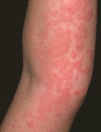 Bumpy Red Rash On Arms Dorothee Padraig South West Skin Health Care