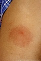 The characteristic bullseye rash for Lyme disease | Innatoss