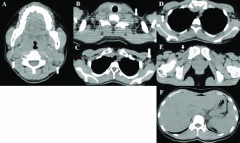 Ct Findings Ct Scans Showed Lymphadenopathy In The A Bilateral