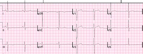 Dr Smiths Ecg Blog St Changes Due To Limb Lead Lvh