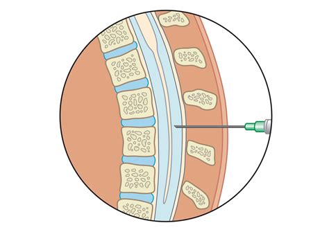 Undergoing A Lumbar Puncture For Your Headache