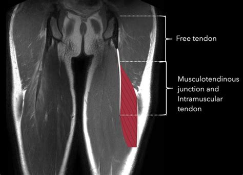 The Radiology Assistant Hamstring Injury