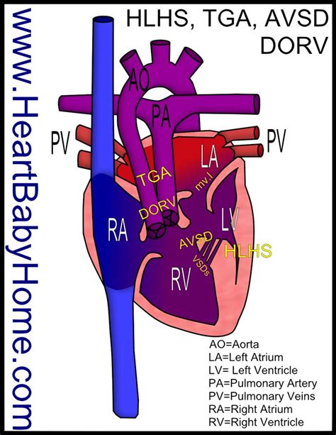 63 Hlhs Dorv Avsd Tga Heart Defect Hypoplastic Left Flickr