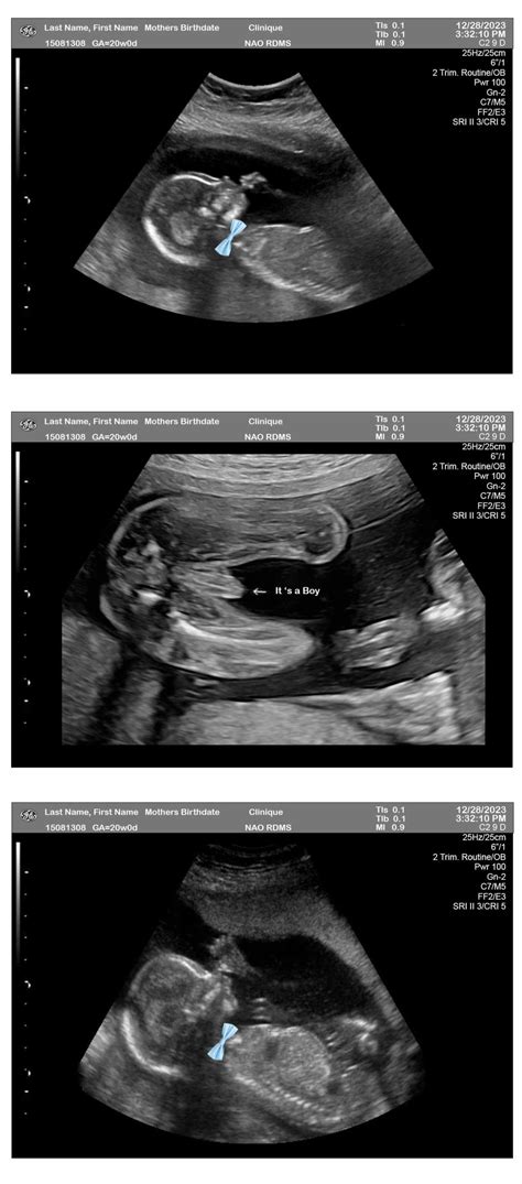 3 Fetuses 20 Weeks Ultrasound Boy Bow Tie Ultrasounds
