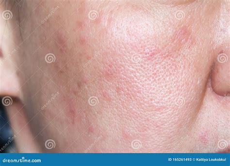 Allergy Rash On The Face Stock Image Image Of Cheek 165261493