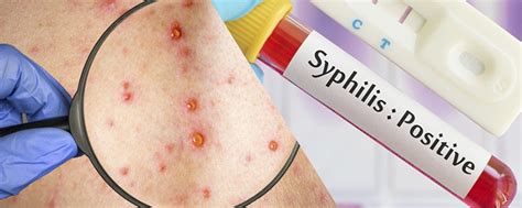 Infección Por Sífilis ¿se Puede Curar Diagnostico En Casa