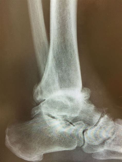 Artrosis de tobillo Dr A D Arrigo Cirugía pie y tobillo