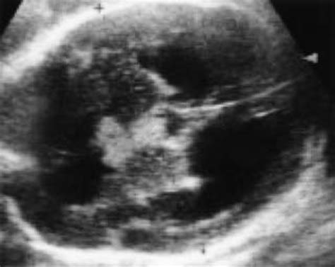 Choroid Plexus Papilloma Of The Third Ventricle In The Fetus In
