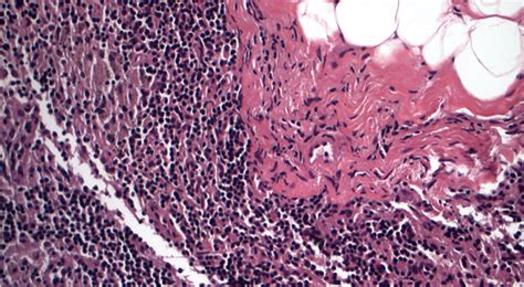 Tiny Bit Of Cancer In Lymph Nodes Leads To Debate On How To Proceed