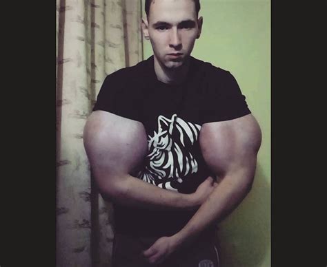 Popeye Bodybuilder Shockingly Injects Chemicals To Enlarge Biceps