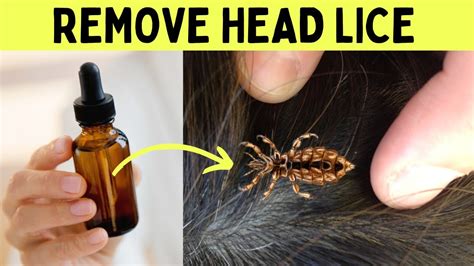How To Get Rid Of Lice And Nits Naturally Permanently And Fast In One