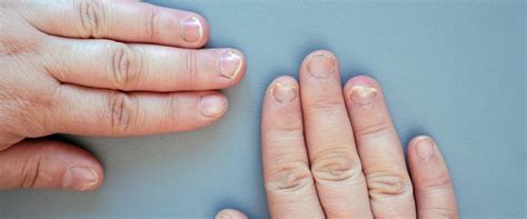 Jak rozpoznać grzybicę paznokci objawy przyczyny sposoby leczenia