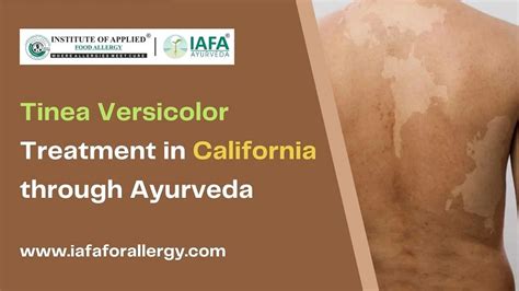 Tinea Versicolor Treatment In California Through Ayurveda