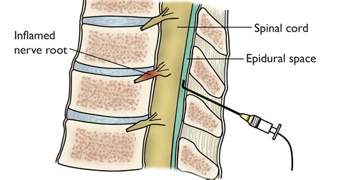 Spinal Injections For Back Pain
